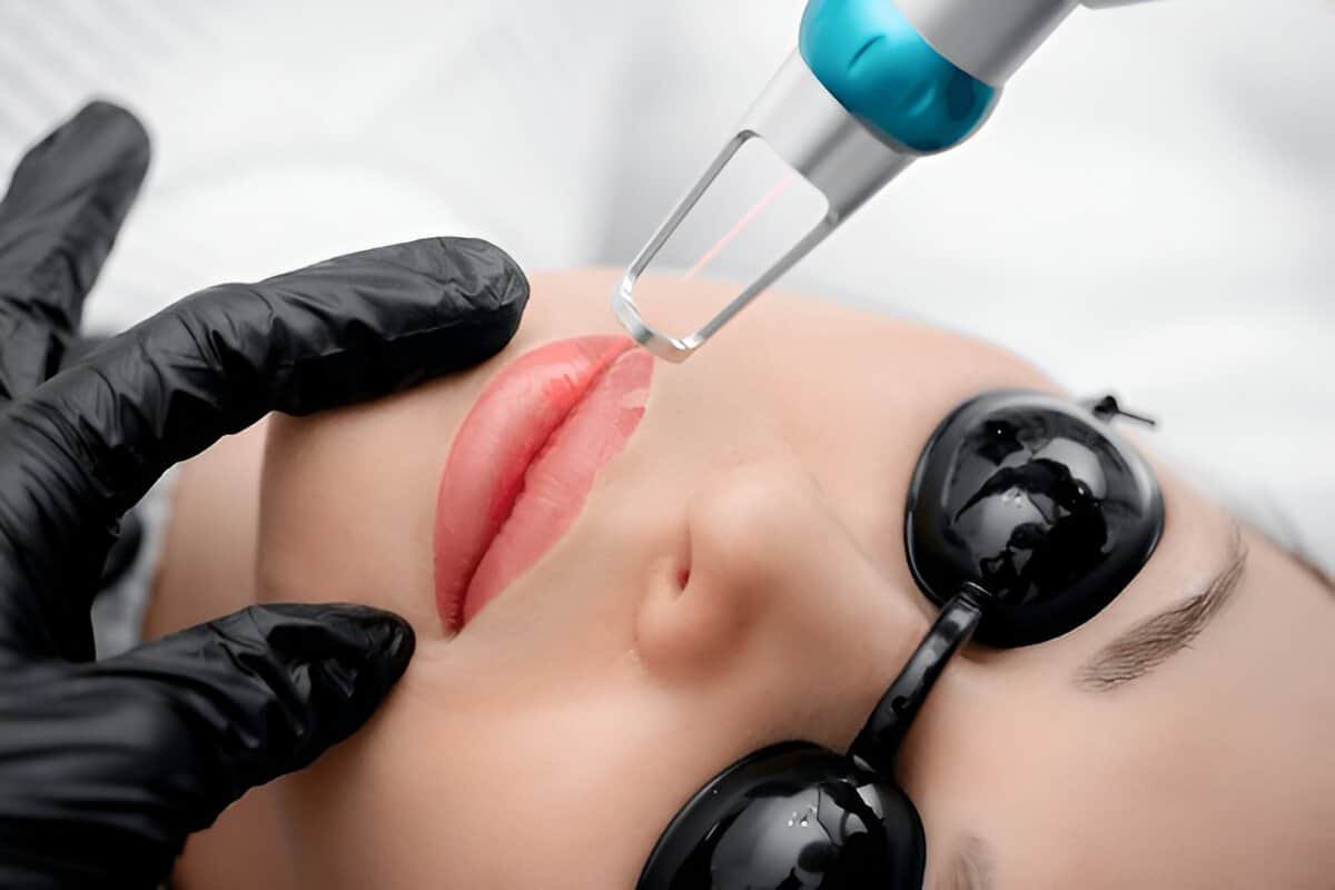 Laser skin treatment being performed on a woman's face at Sasha Aesthetic Clinic.