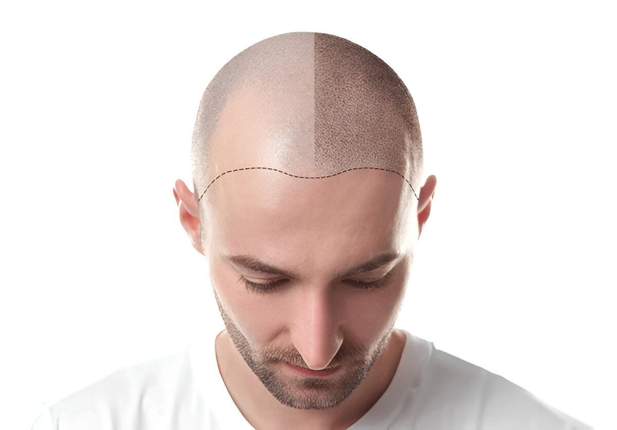 Man with a marked scalp for hair transplant procedure at Sasha Aesthetic Clinic.