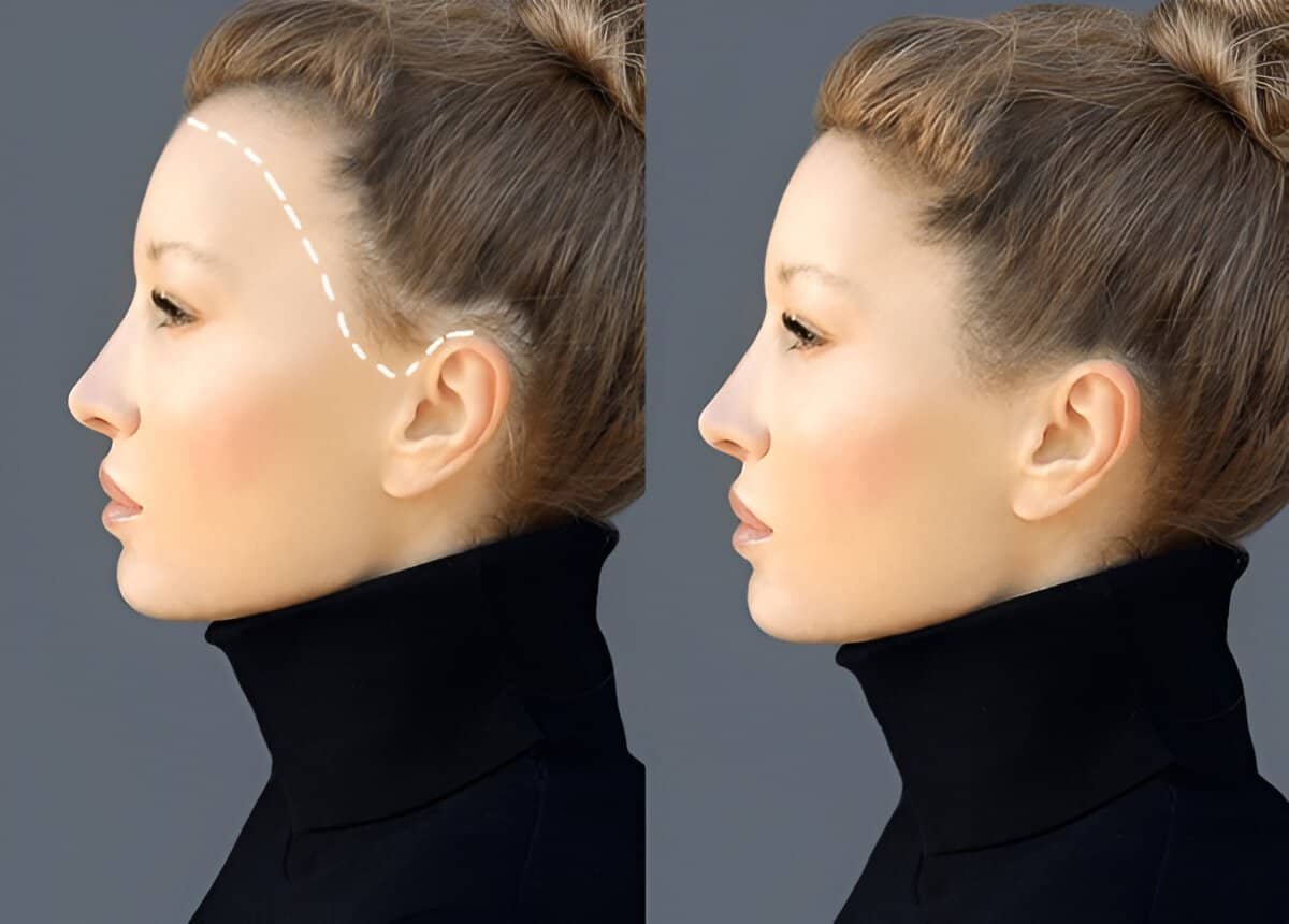 Refined facial profile with non-invasive aesthetic procedures.