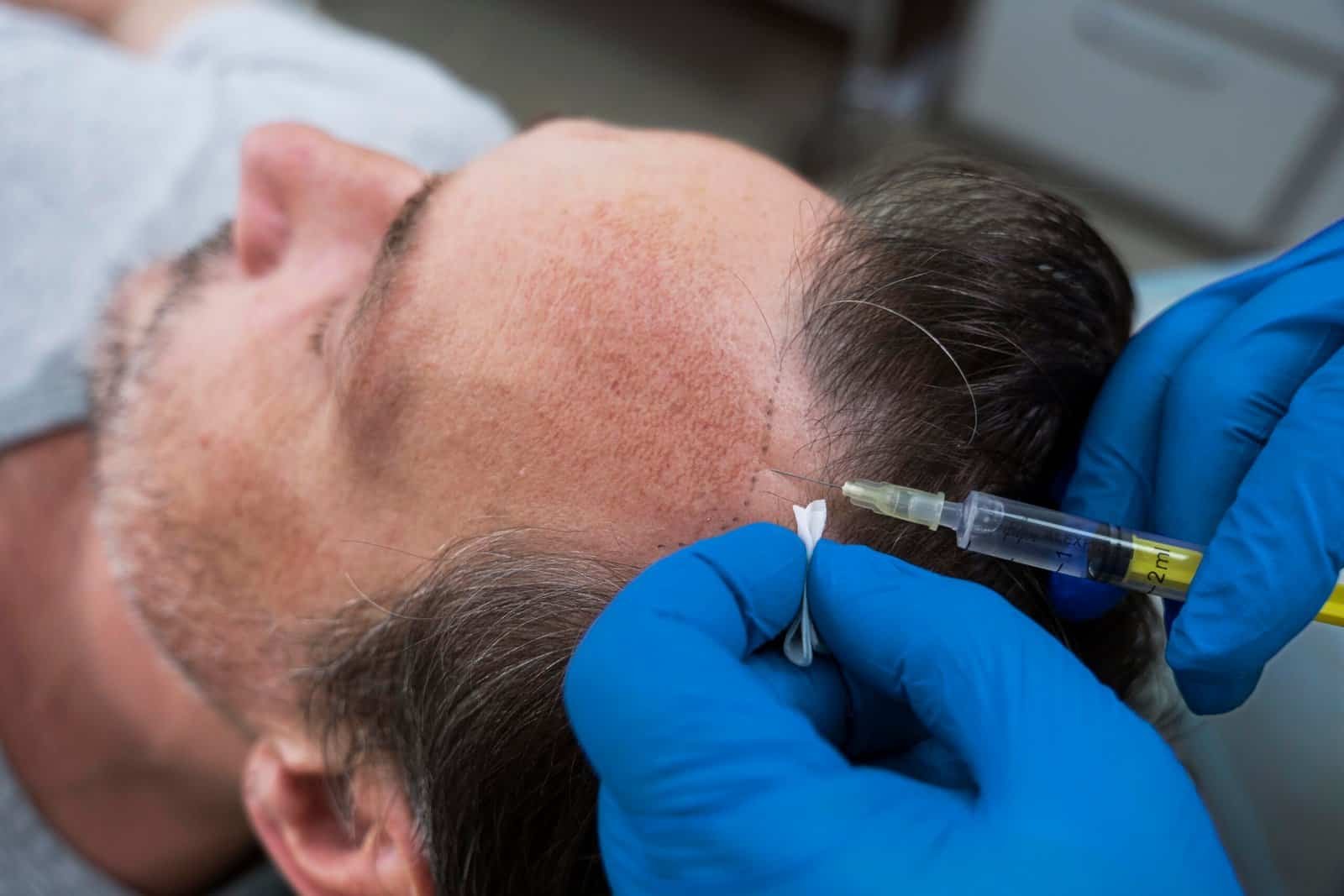 Hair transplant procedure being performed on a male patient.