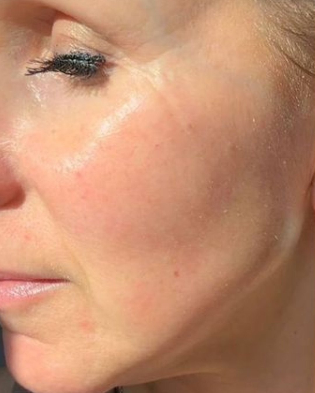 After fillers treatment